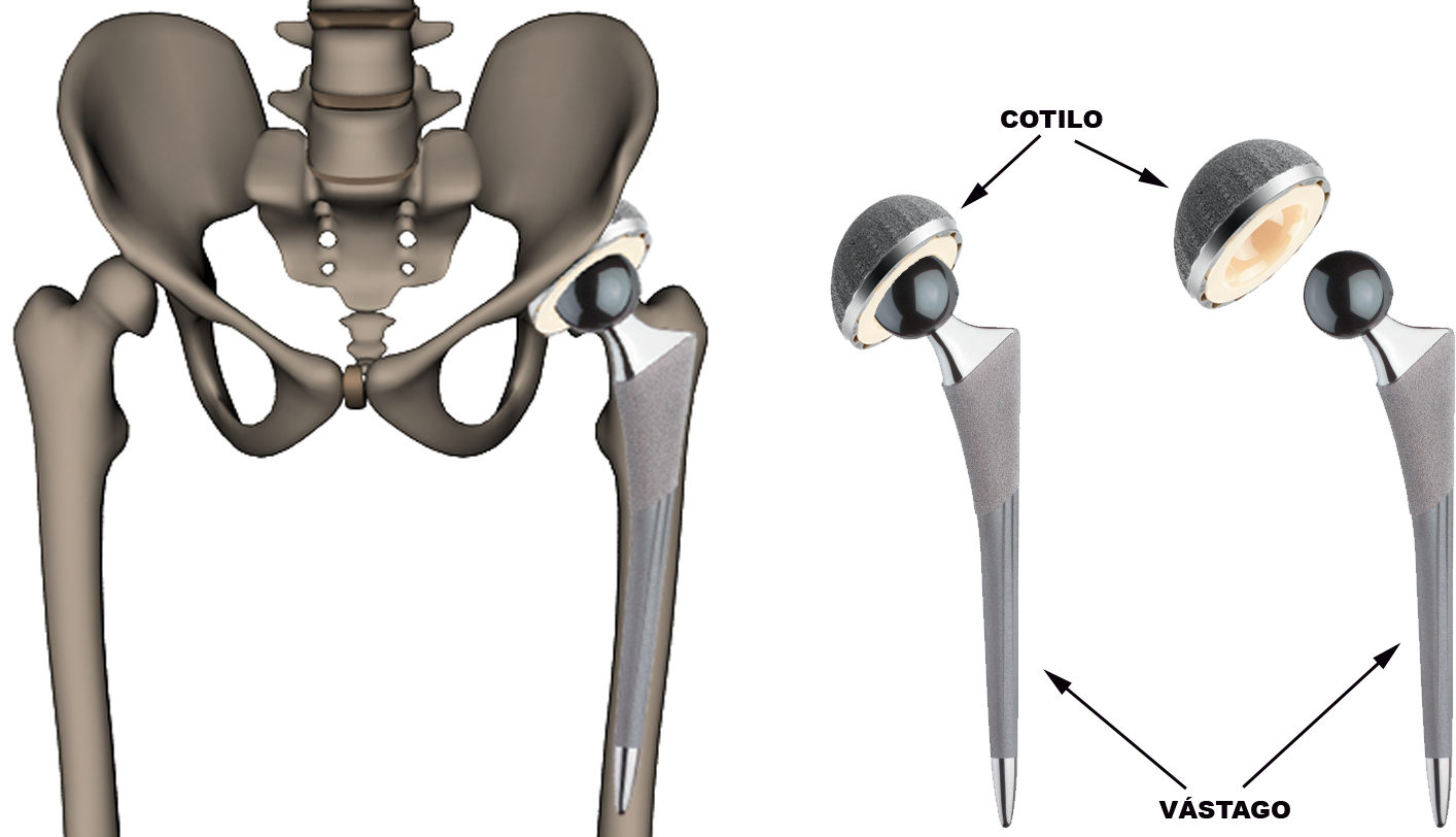 Prótesis de cadera
