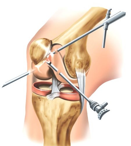 artroscopia total de rodilla